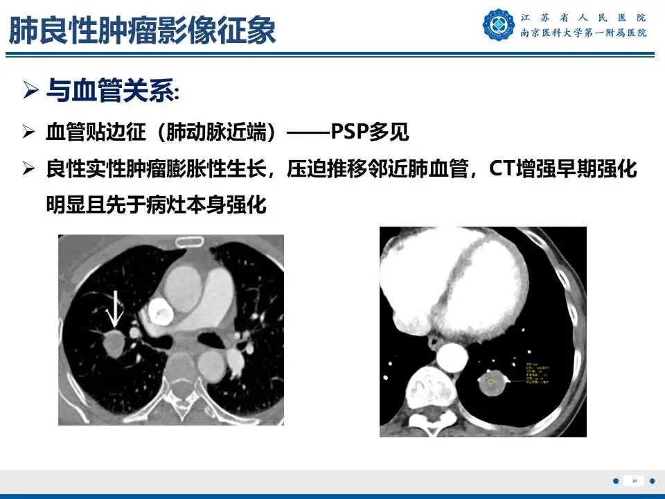 影像PPT - 【PPT】肺硬化性肺泡细胞瘤-21