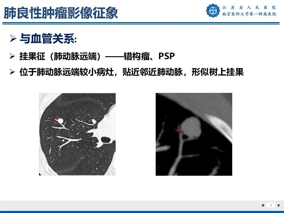 影像PPT - 【PPT】肺硬化性肺泡细胞瘤-22