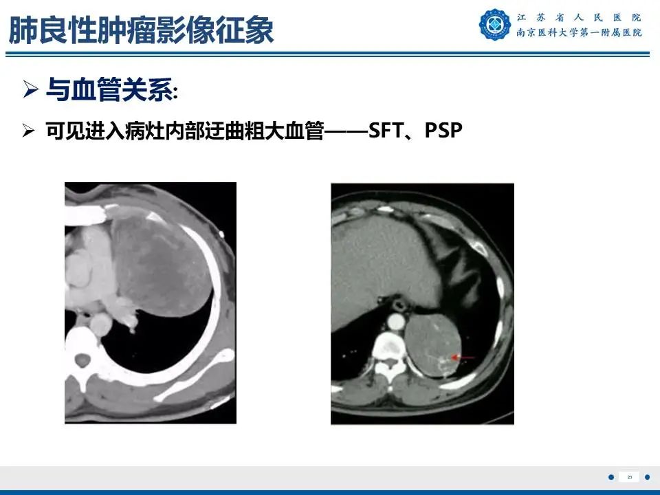 影像PPT - 【PPT】肺硬化性肺泡细胞瘤-24