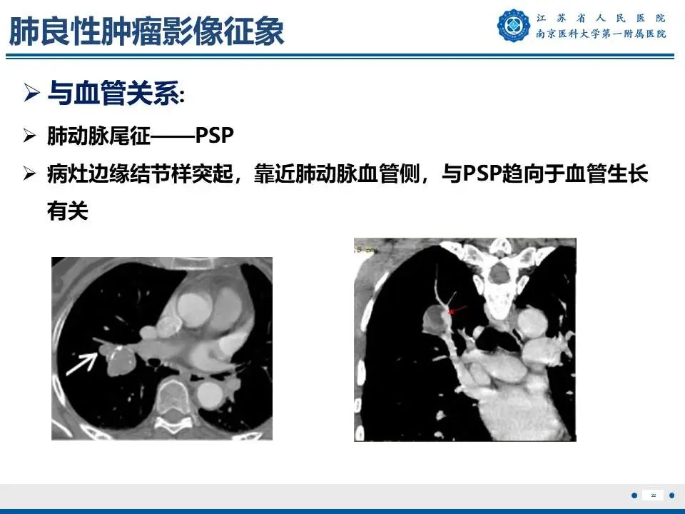 影像PPT - 【PPT】肺硬化性肺泡细胞瘤-23