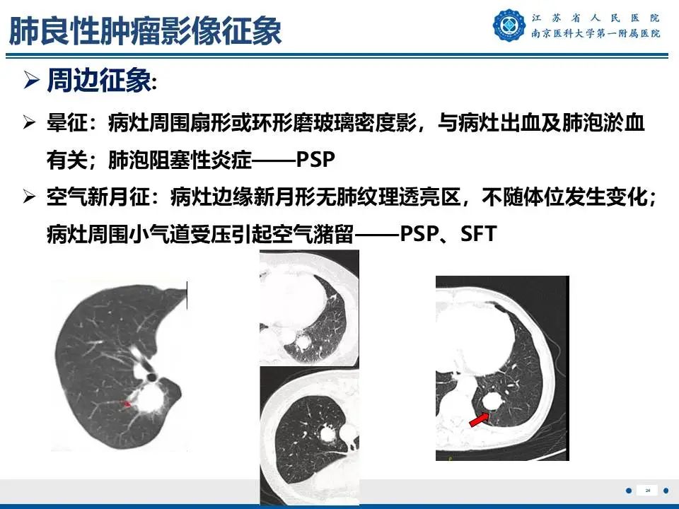 影像PPT - 【PPT】肺硬化性肺泡细胞瘤-25