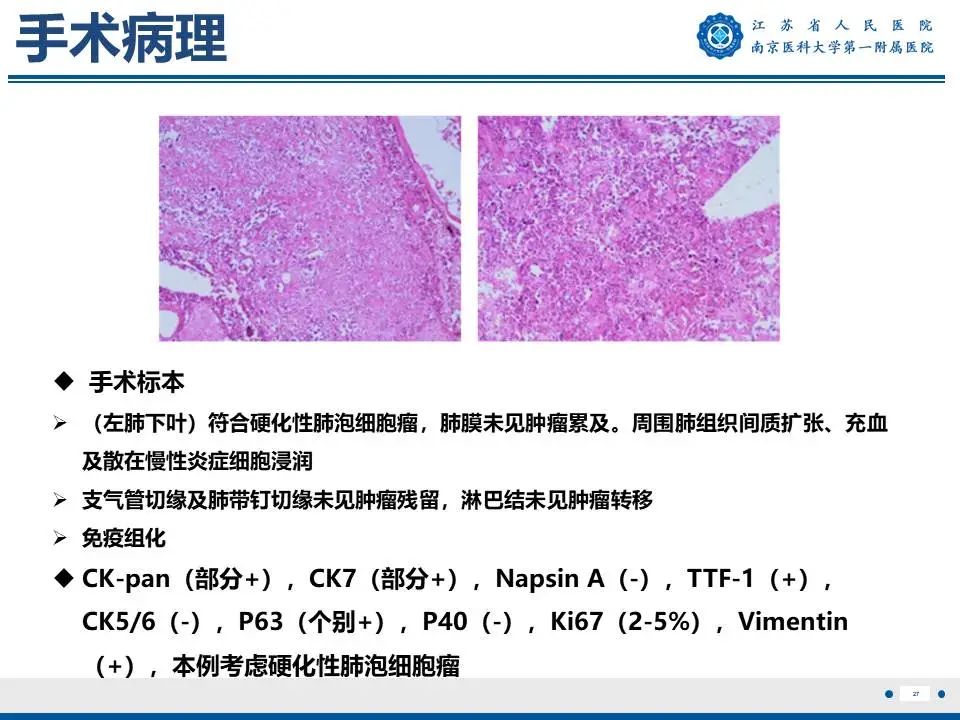 影像PPT - 【PPT】肺硬化性肺泡细胞瘤-28