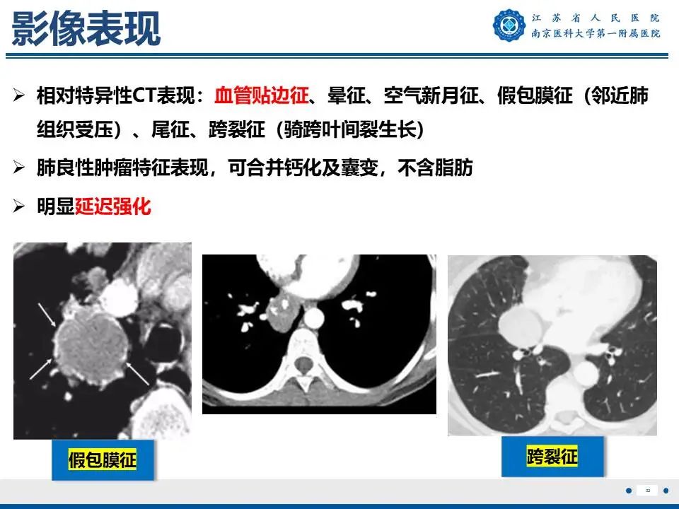 影像PPT - 【PPT】肺硬化性肺泡细胞瘤-33