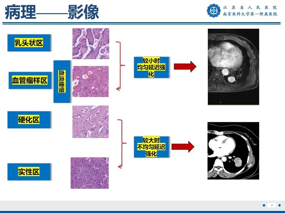 影像PPT - 【PPT】肺硬化性肺泡细胞瘤-32