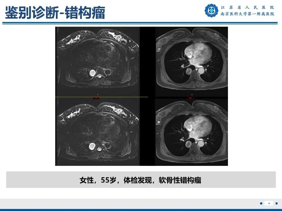 影像PPT - 【PPT】肺硬化性肺泡细胞瘤-36