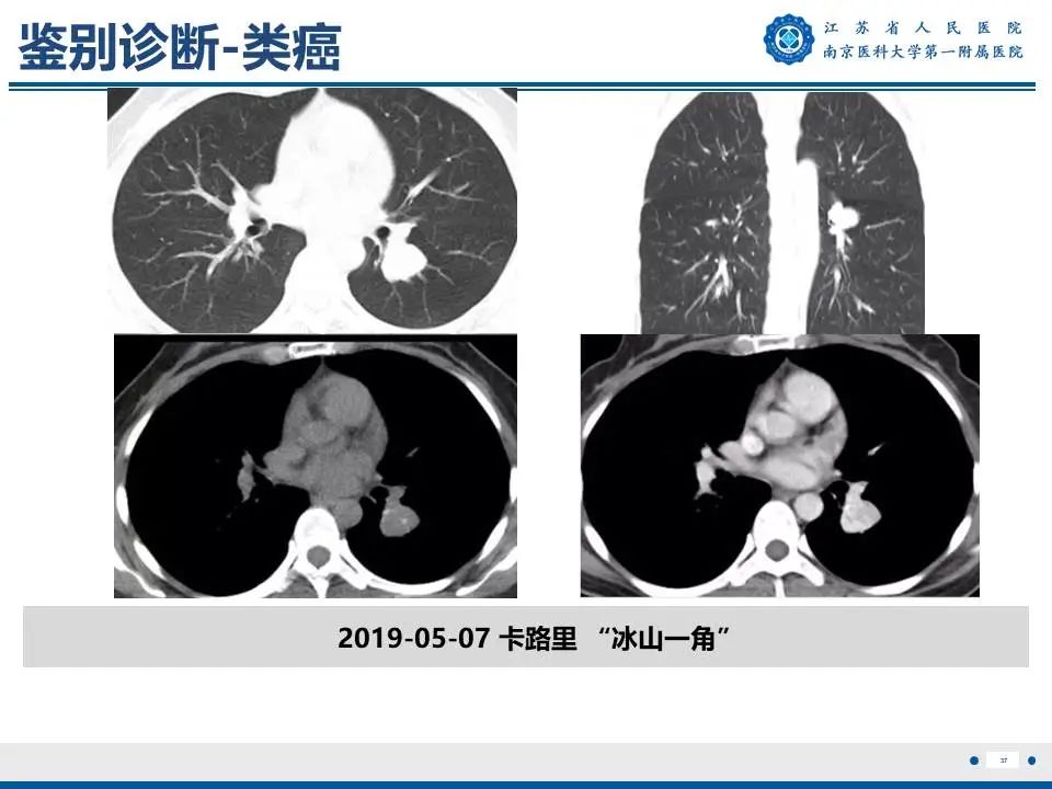 影像PPT - 【PPT】肺硬化性肺泡细胞瘤-38