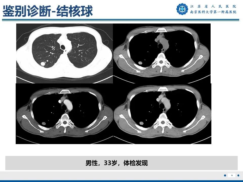 影像PPT - 【PPT】肺硬化性肺泡细胞瘤-40
