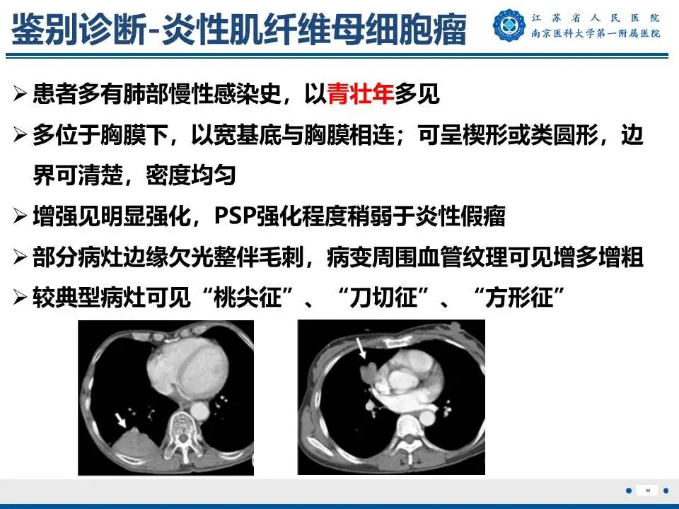 影像PPT - 【PPT】肺硬化性肺泡细胞瘤-41