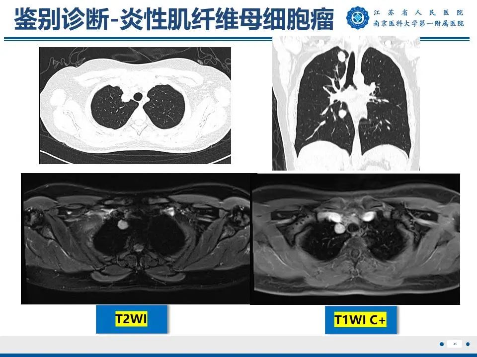 影像PPT - 【PPT】肺硬化性肺泡细胞瘤-42