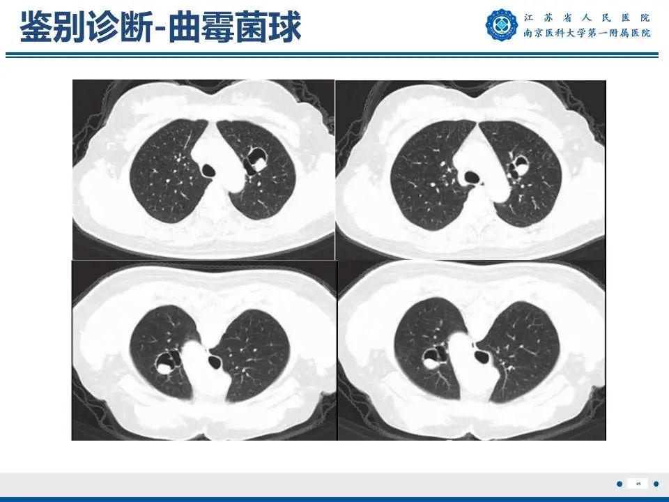 影像PPT - 【PPT】肺硬化性肺泡细胞瘤-46