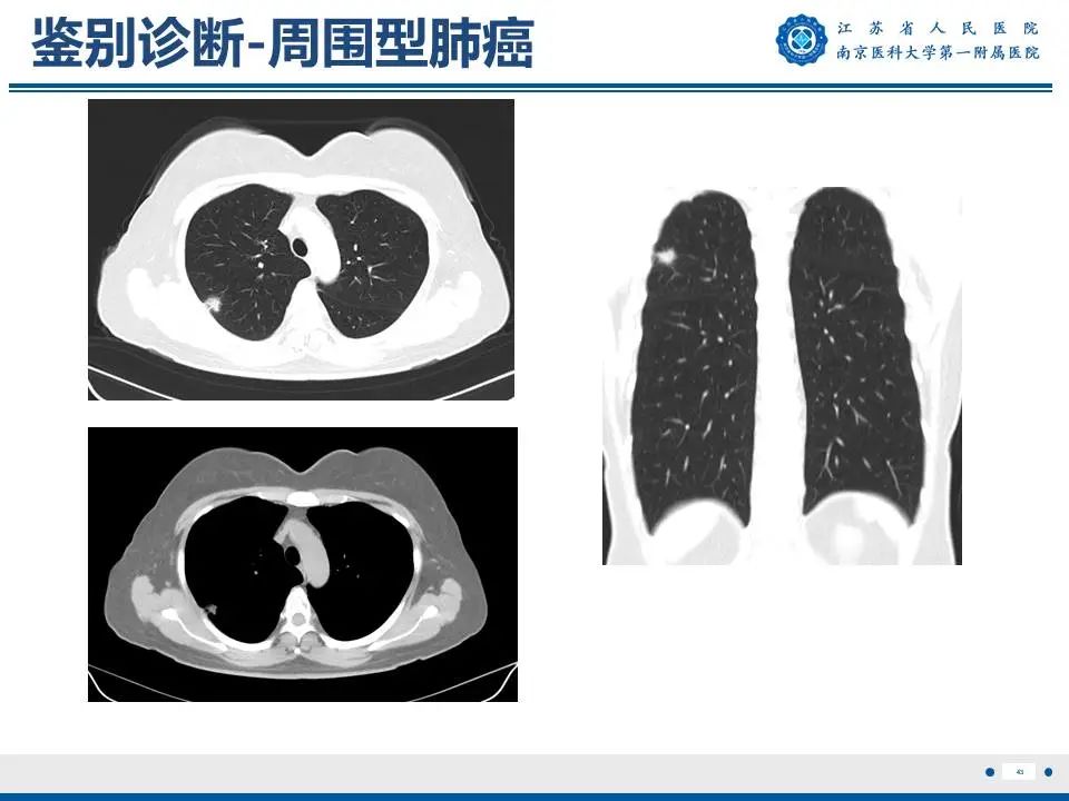 影像PPT - 【PPT】肺硬化性肺泡细胞瘤-44