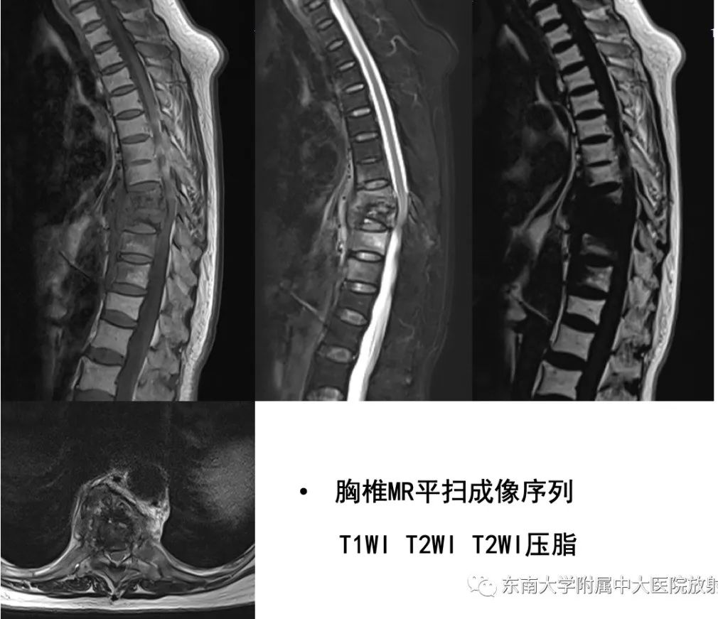 影像PPT - 【PPT】脊柱结核影像诊断-2 影像PPT - 【PPT】脊柱结核影像诊断-2
