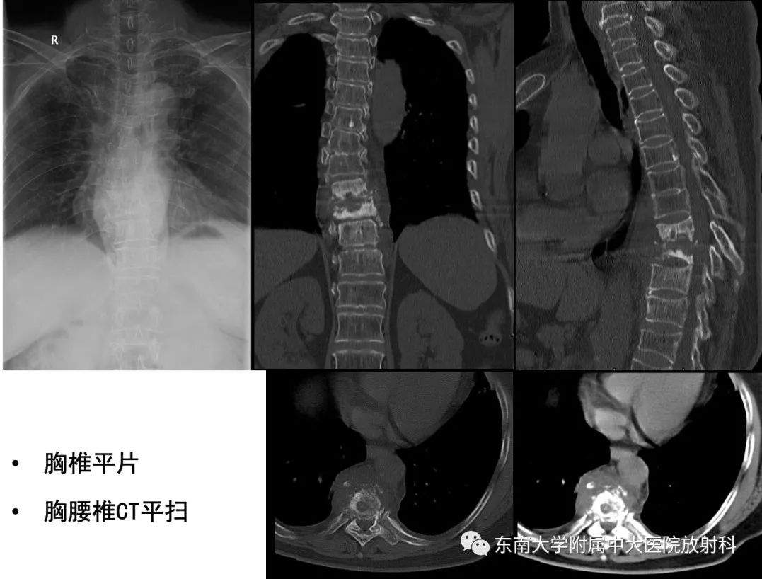 影像PPT - 【PPT】脊柱结核影像诊断-1 影像PPT - 【PPT】脊柱结核影像诊断-1