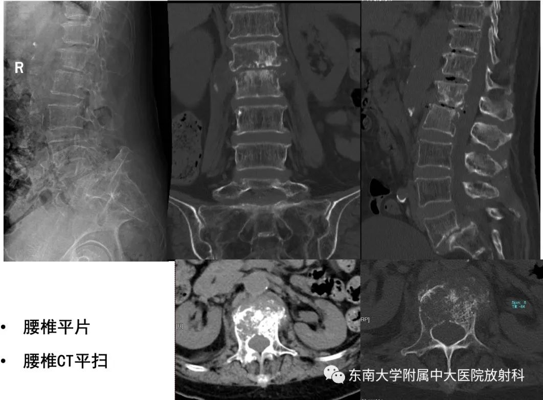 影像PPT - 【PPT】脊柱结核影像诊断-4 影像PPT - 【PPT】脊柱结核影像诊断-4