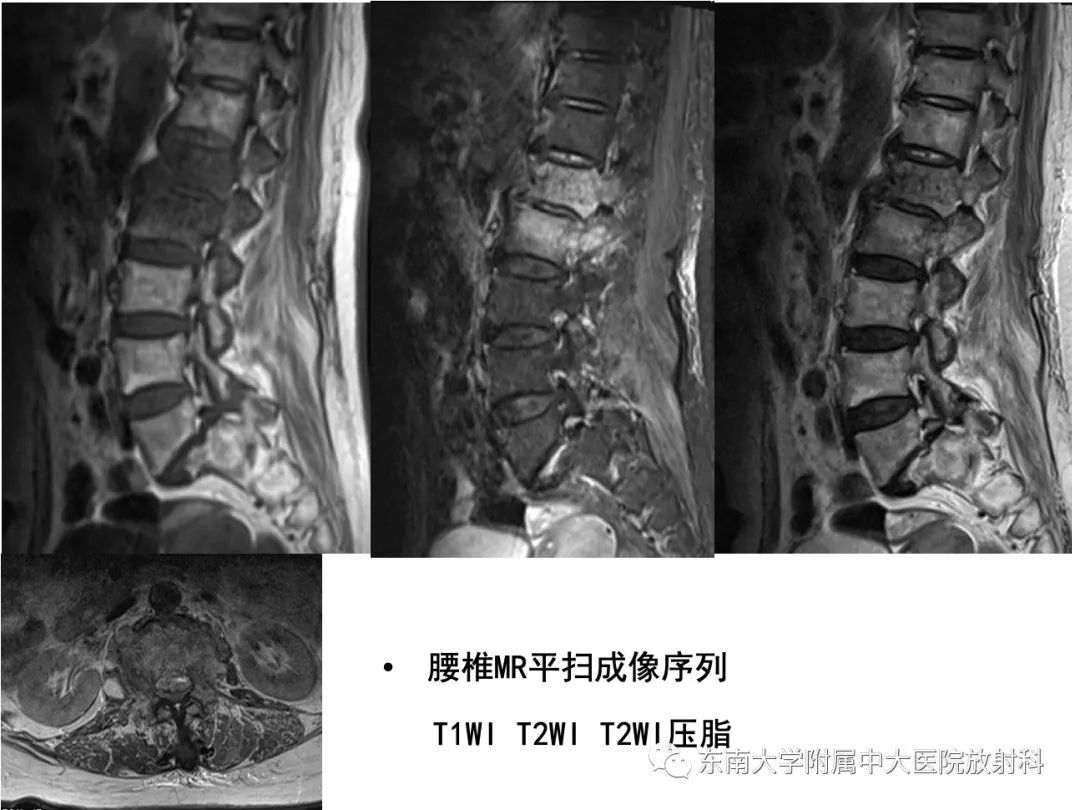 影像PPT - 【PPT】脊柱结核影像诊断-5 影像PPT - 【PPT】脊柱结核影像诊断-5