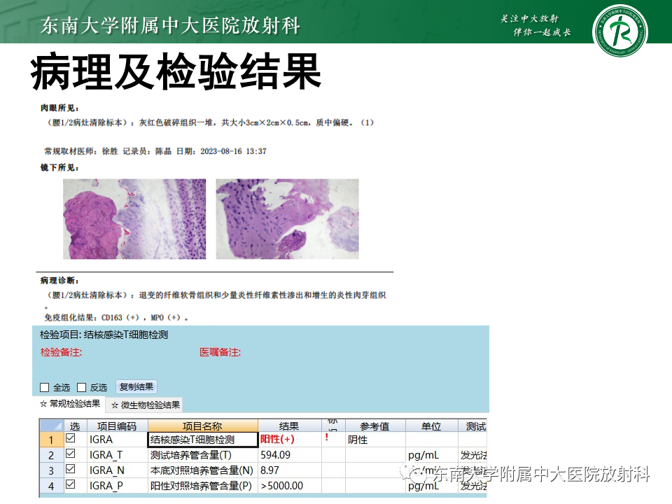 影像PPT - 【PPT】脊柱结核影像诊断-6 影像PPT - 【PPT】脊柱结核影像诊断-6