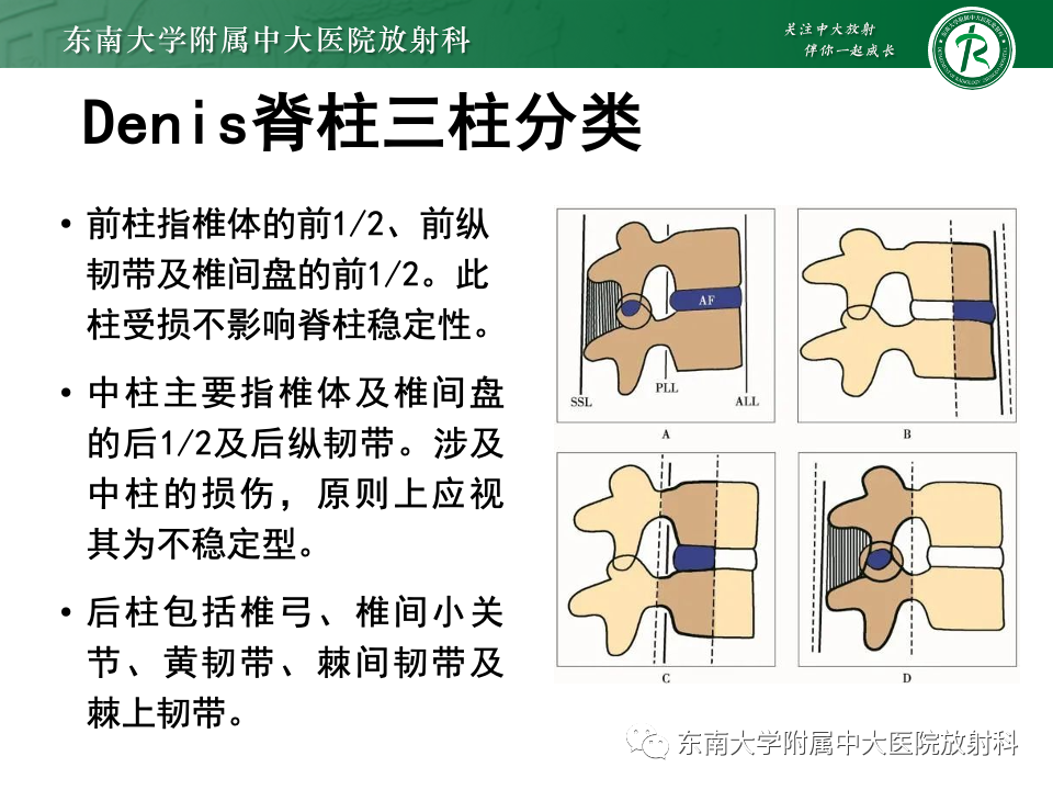 影像PPT - 【PPT】脊柱结核影像诊断-11 影像PPT - 【PPT】脊柱结核影像诊断-11
