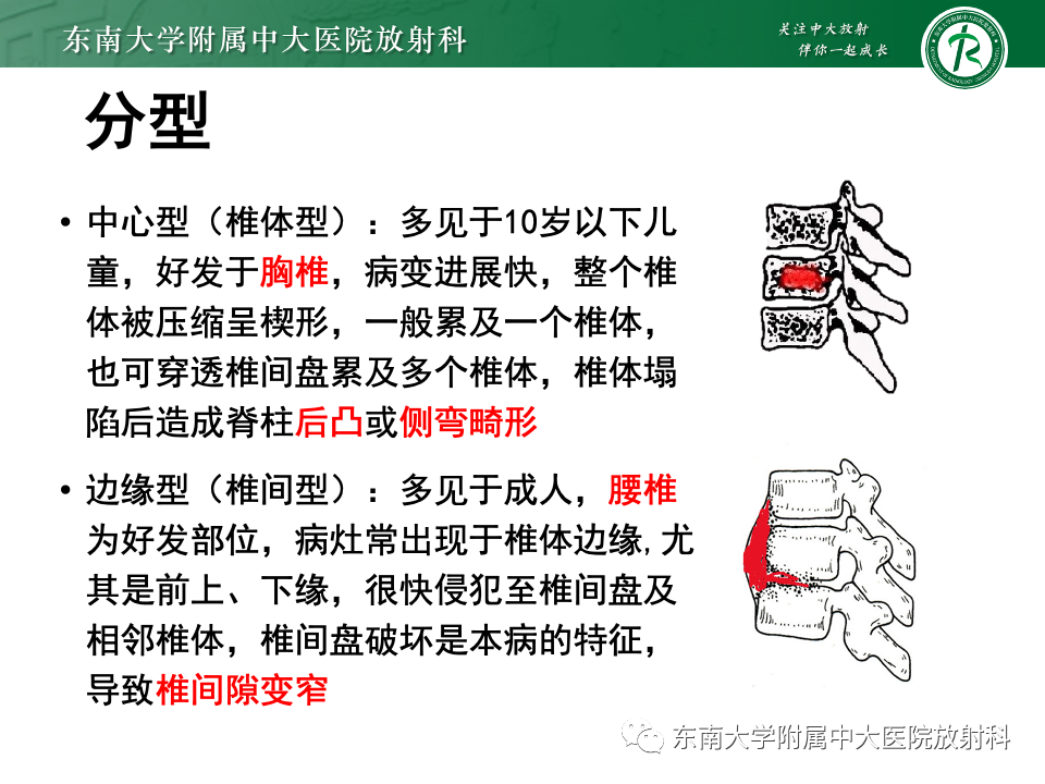 影像PPT - 【PPT】脊柱结核影像诊断-12 影像PPT - 【PPT】脊柱结核影像诊断-12