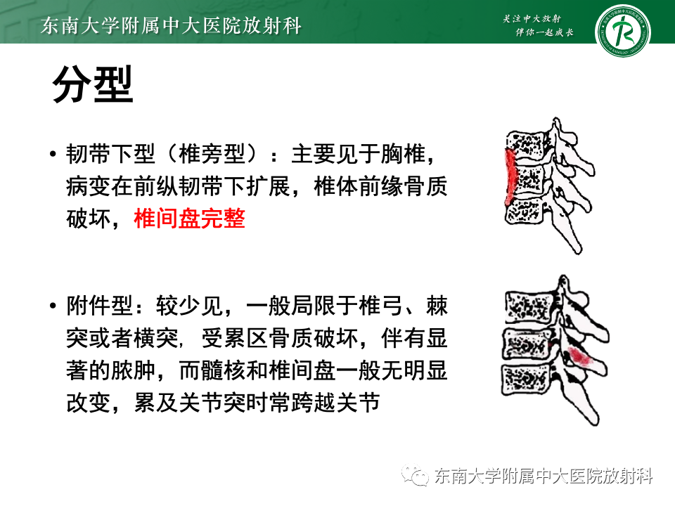 影像PPT - 【PPT】脊柱结核影像诊断-13 影像PPT - 【PPT】脊柱结核影像诊断-13