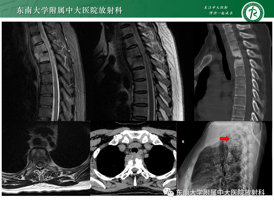 影像PPT - 【PPT】脊柱结核影像诊断-22 影像PPT - 【PPT】脊柱结核影像诊断-22