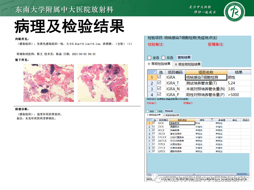 影像PPT - 【PPT】脊柱结核影像诊断-23 影像PPT - 【PPT】脊柱结核影像诊断-23