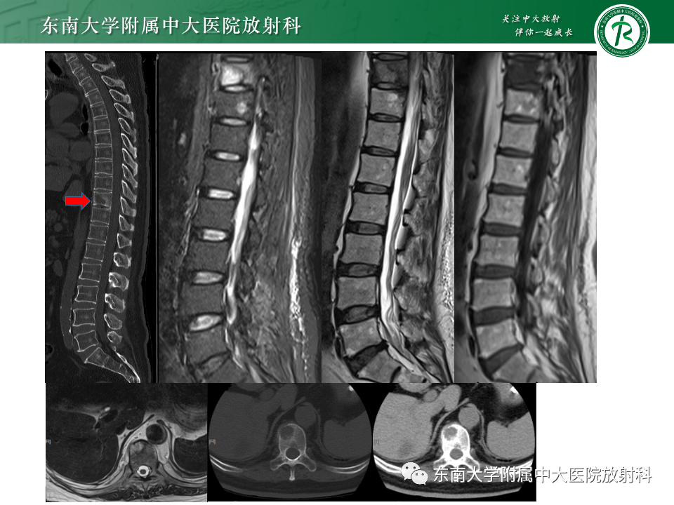 影像PPT - 【PPT】脊柱结核影像诊断-27 影像PPT - 【PPT】脊柱结核影像诊断-27