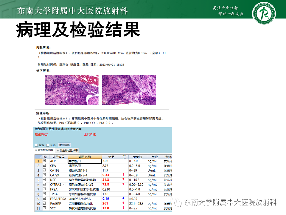 影像PPT - 【PPT】脊柱结核影像诊断-28 影像PPT - 【PPT】脊柱结核影像诊断-28