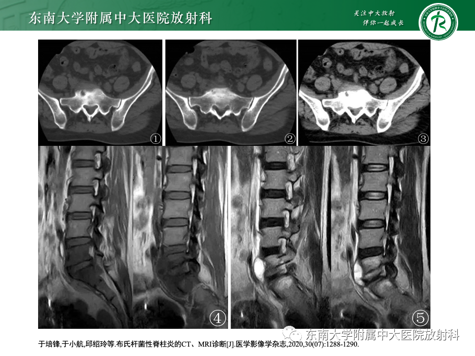 影像PPT - 【PPT】脊柱结核影像诊断-31 影像PPT - 【PPT】脊柱结核影像诊断-31