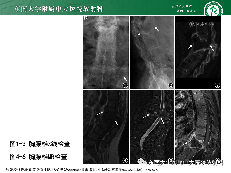 影像PPT - 【PPT】脊柱结核影像诊断-34 影像PPT - 【PPT】脊柱结核影像诊断-34