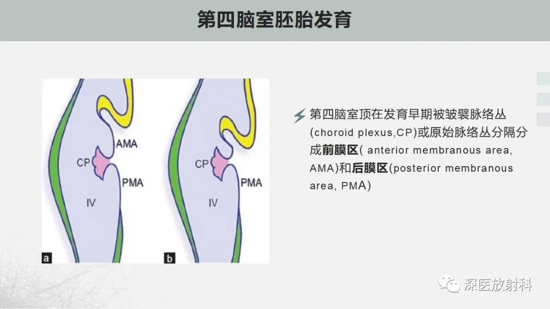 影像PPT - 【PPT】胎儿和新生儿后颅窝畸形的影像诊断-5