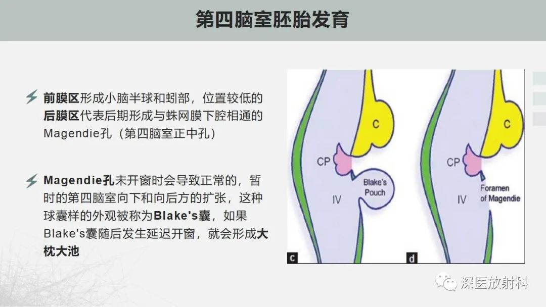 影像PPT - 【PPT】胎儿和新生儿后颅窝畸形的影像诊断-6