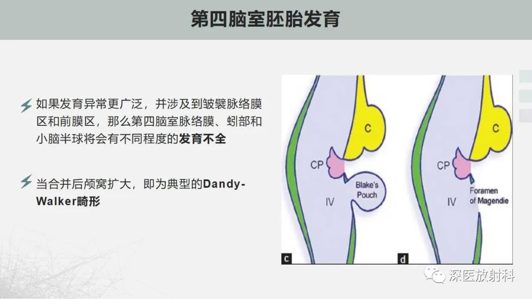 影像PPT - 【PPT】胎儿和新生儿后颅窝畸形的影像诊断-7