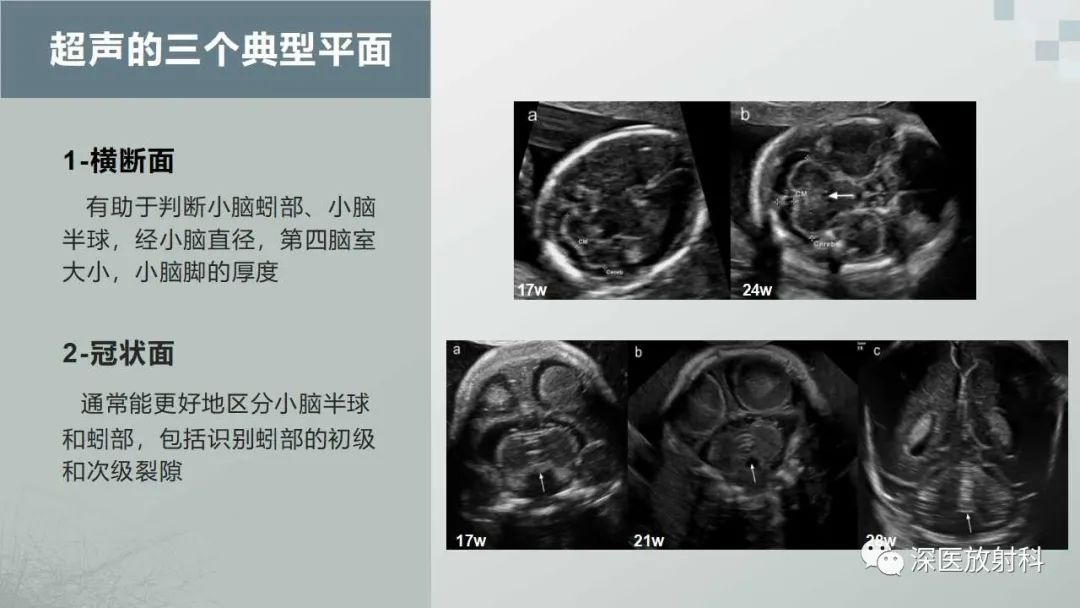 影像PPT - 【PPT】胎儿和新生儿后颅窝畸形的影像诊断-10