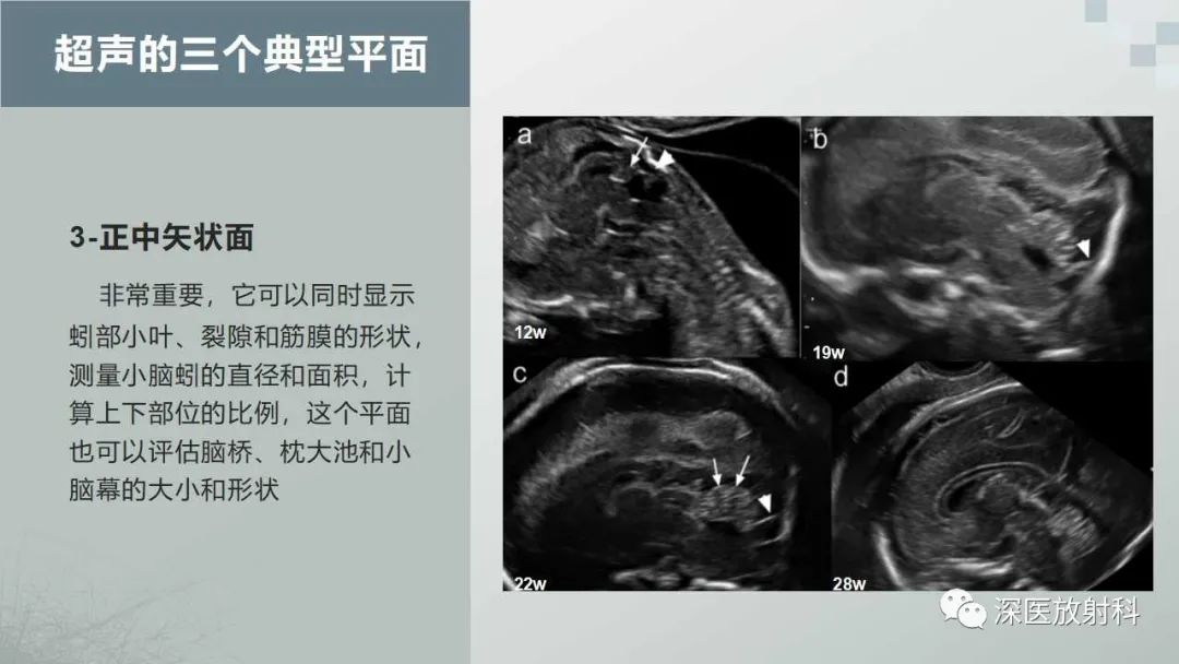 影像PPT - 【PPT】胎儿和新生儿后颅窝畸形的影像诊断-11