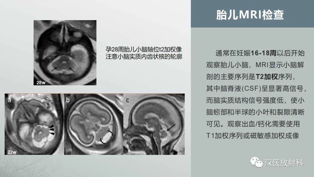 影像PPT - 【PPT】胎儿和新生儿后颅窝畸形的影像诊断-12