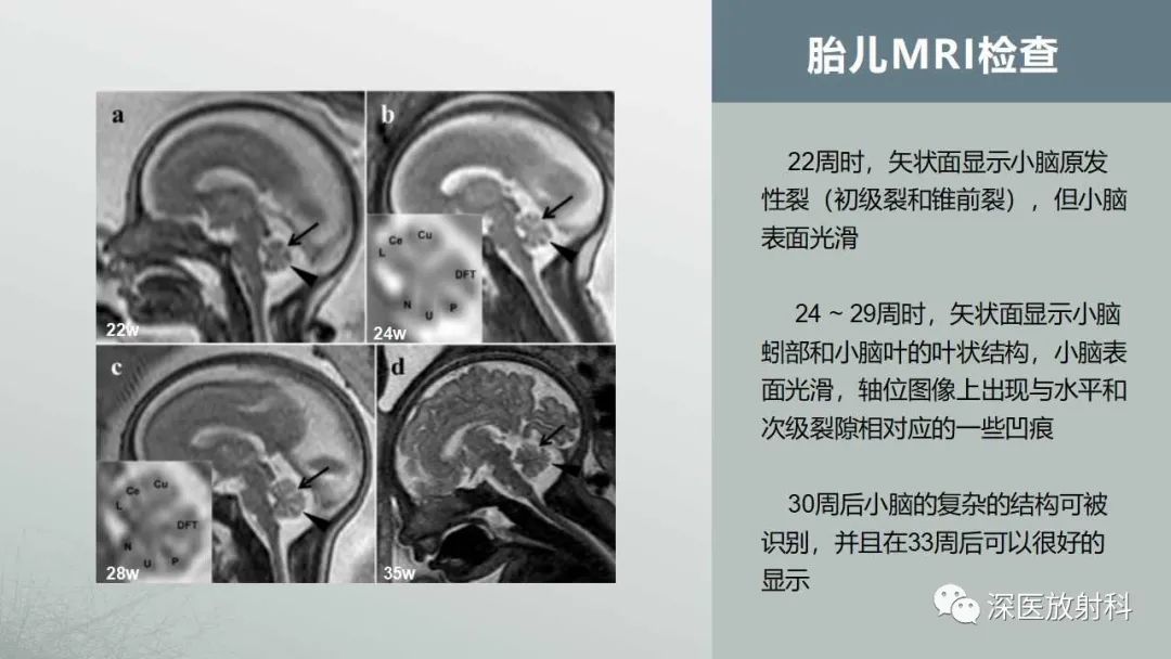 影像PPT - 【PPT】胎儿和新生儿后颅窝畸形的影像诊断-13