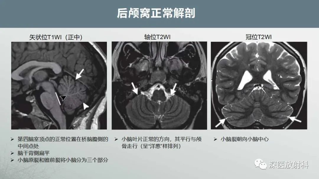 影像PPT - 【PPT】胎儿和新生儿后颅窝畸形的影像诊断-14