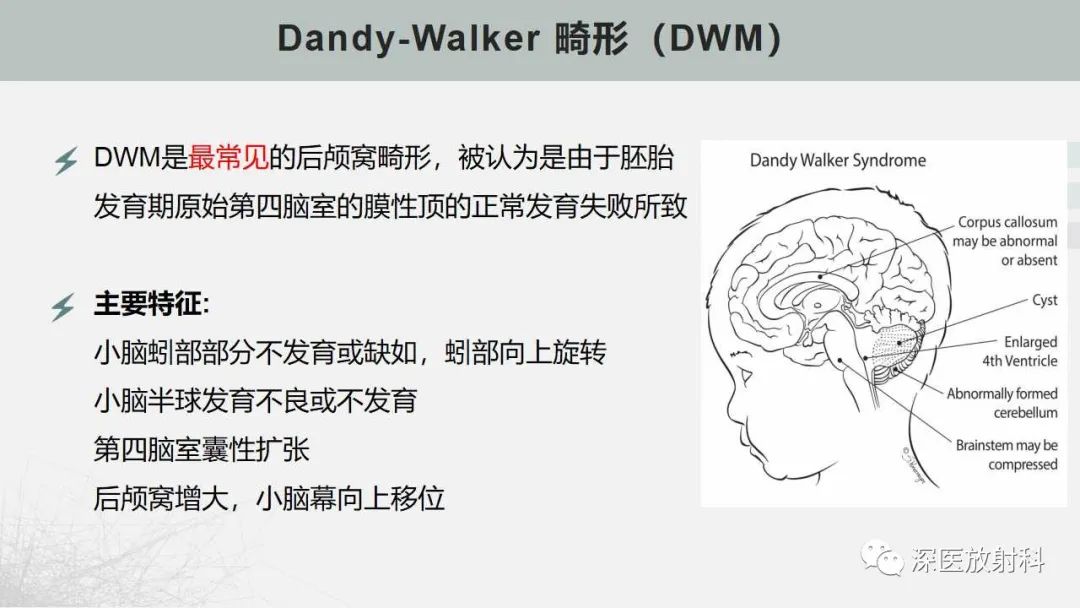 影像PPT - 【PPT】胎儿和新生儿后颅窝畸形的影像诊断-17