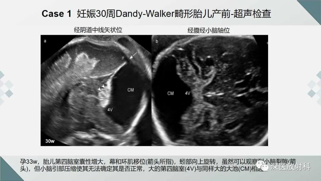 影像PPT - 【PPT】胎儿和新生儿后颅窝畸形的影像诊断-19