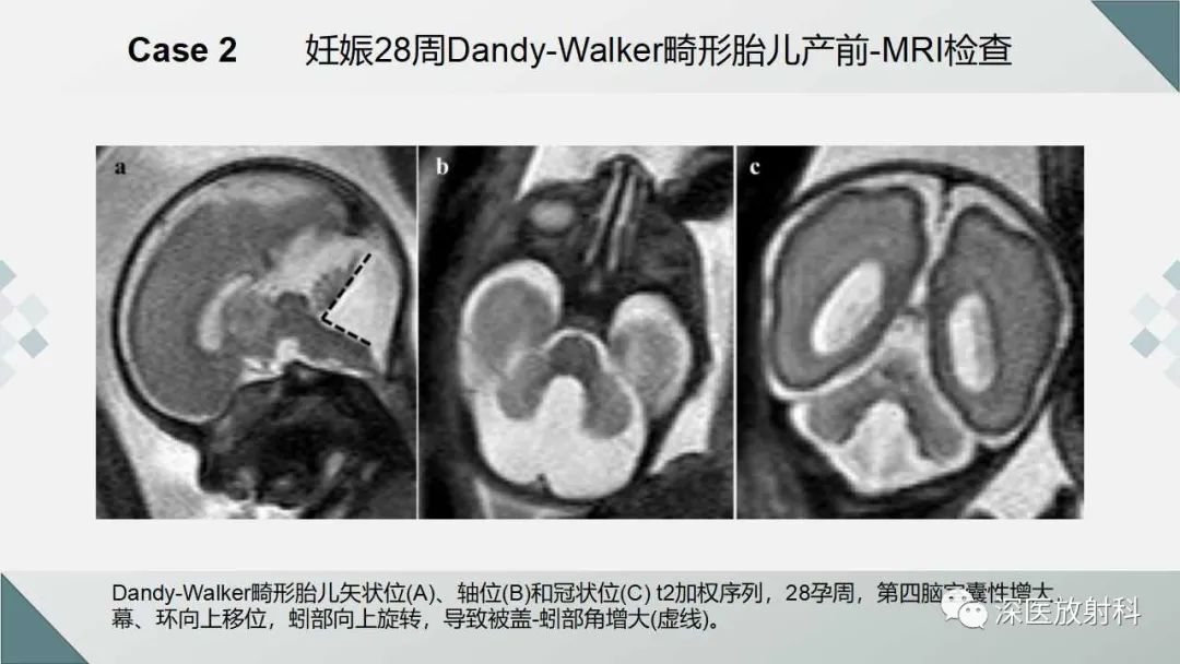 影像PPT - 【PPT】胎儿和新生儿后颅窝畸形的影像诊断-20
