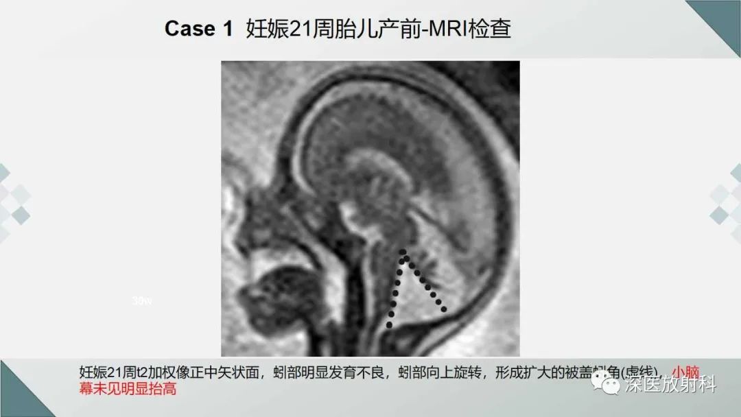 影像PPT - 【PPT】胎儿和新生儿后颅窝畸形的影像诊断-22