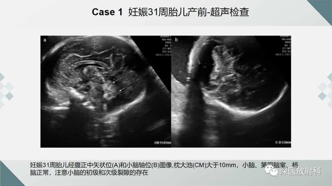 影像PPT - 【PPT】胎儿和新生儿后颅窝畸形的影像诊断-24
