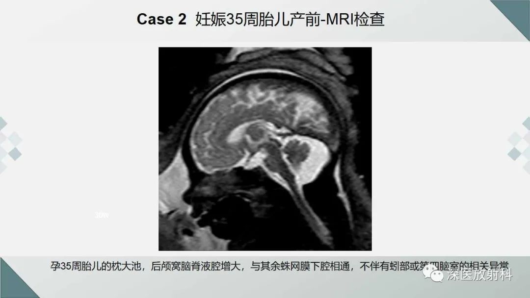 影像PPT - 【PPT】胎儿和新生儿后颅窝畸形的影像诊断-25
