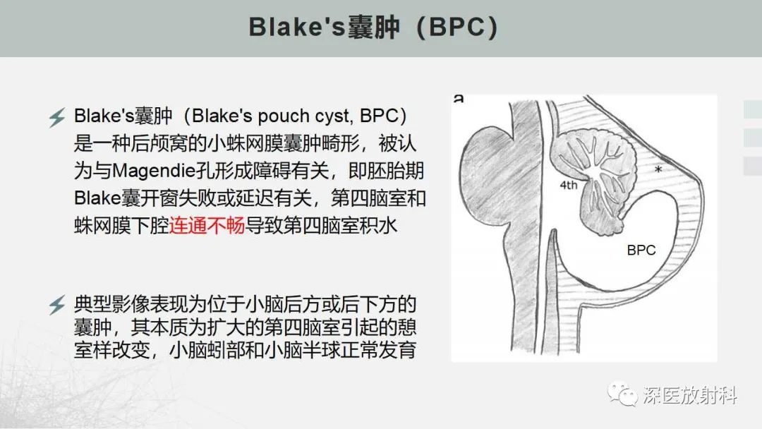 影像PPT - 【PPT】胎儿和新生儿后颅窝畸形的影像诊断-26