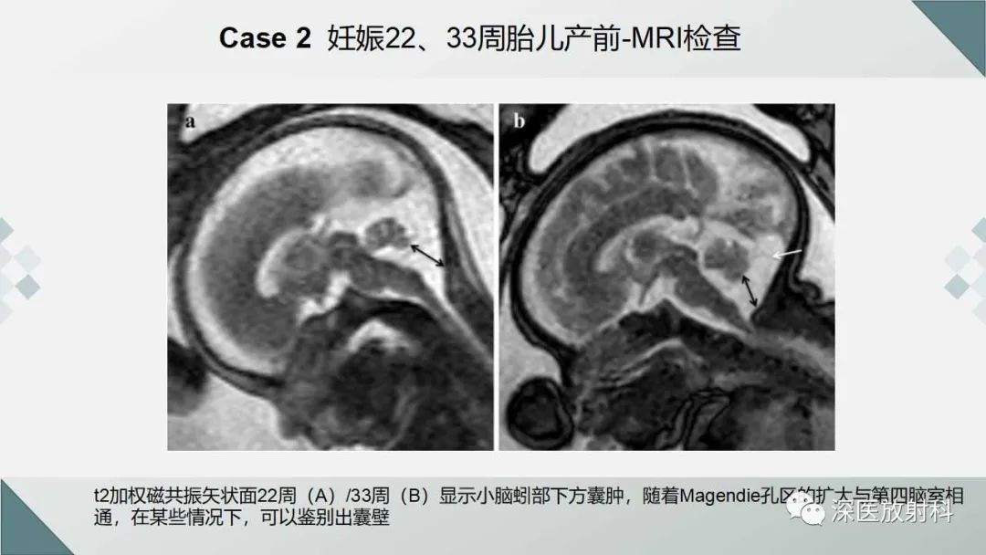 影像PPT - 【PPT】胎儿和新生儿后颅窝畸形的影像诊断-28