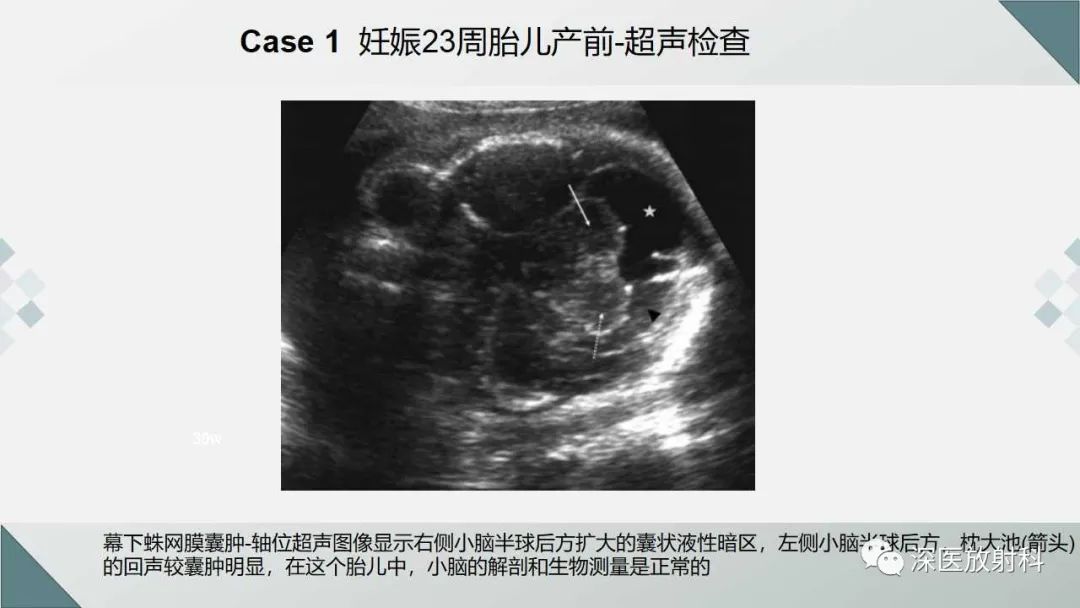 影像PPT - 【PPT】胎儿和新生儿后颅窝畸形的影像诊断-30