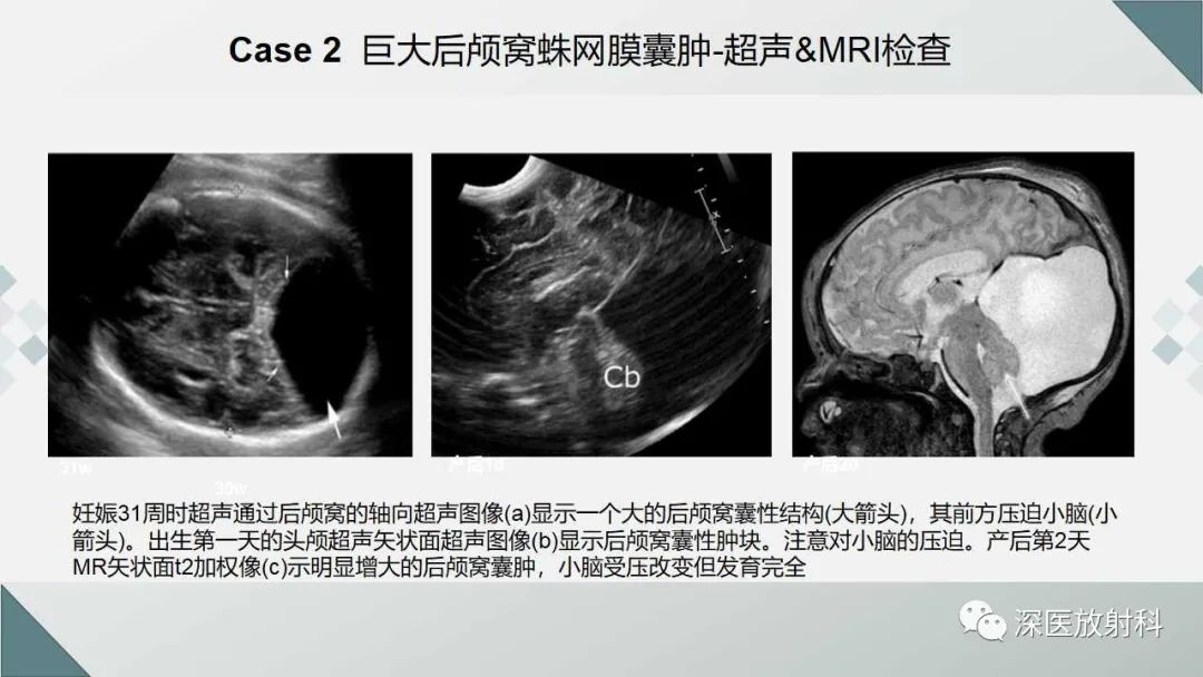 影像PPT - 【PPT】胎儿和新生儿后颅窝畸形的影像诊断-31