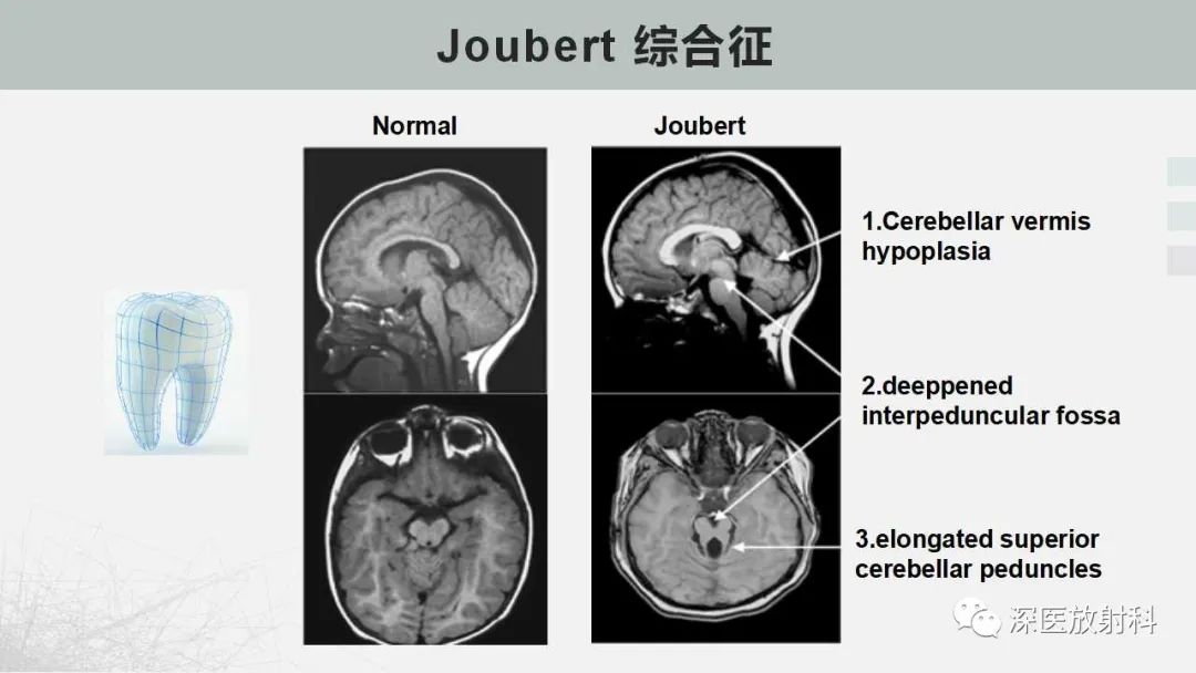 影像PPT - 【PPT】胎儿和新生儿后颅窝畸形的影像诊断-33