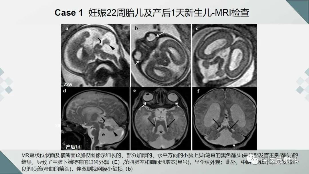 影像PPT - 【PPT】胎儿和新生儿后颅窝畸形的影像诊断-34