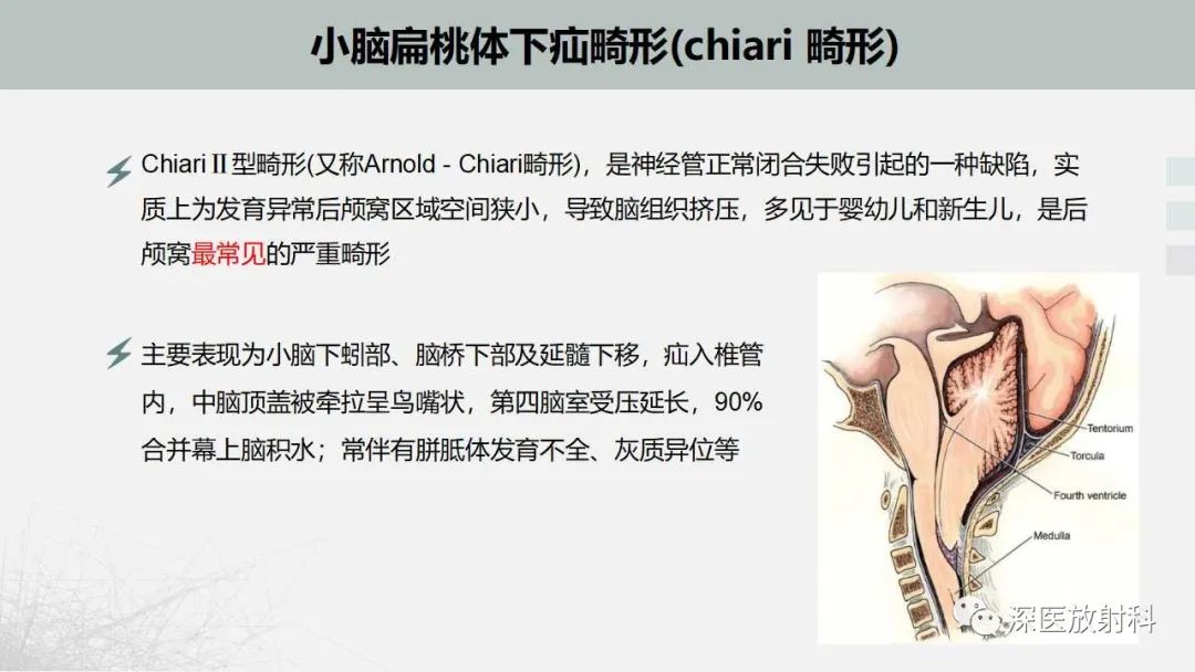 影像PPT - 【PPT】胎儿和新生儿后颅窝畸形的影像诊断-35